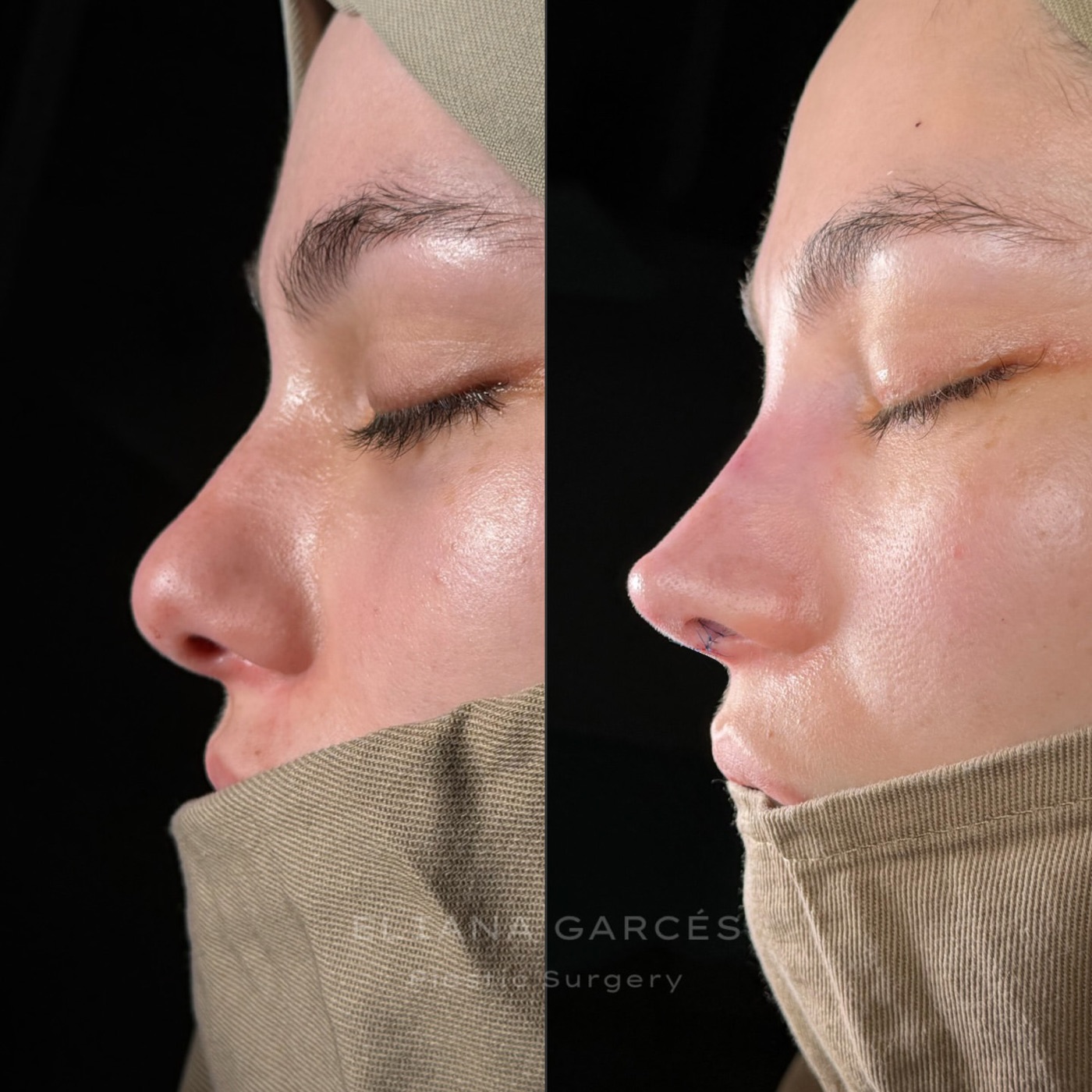 Perfil de una paciente antes de la rinoplastia, a la izquierda, y después, a la derecha