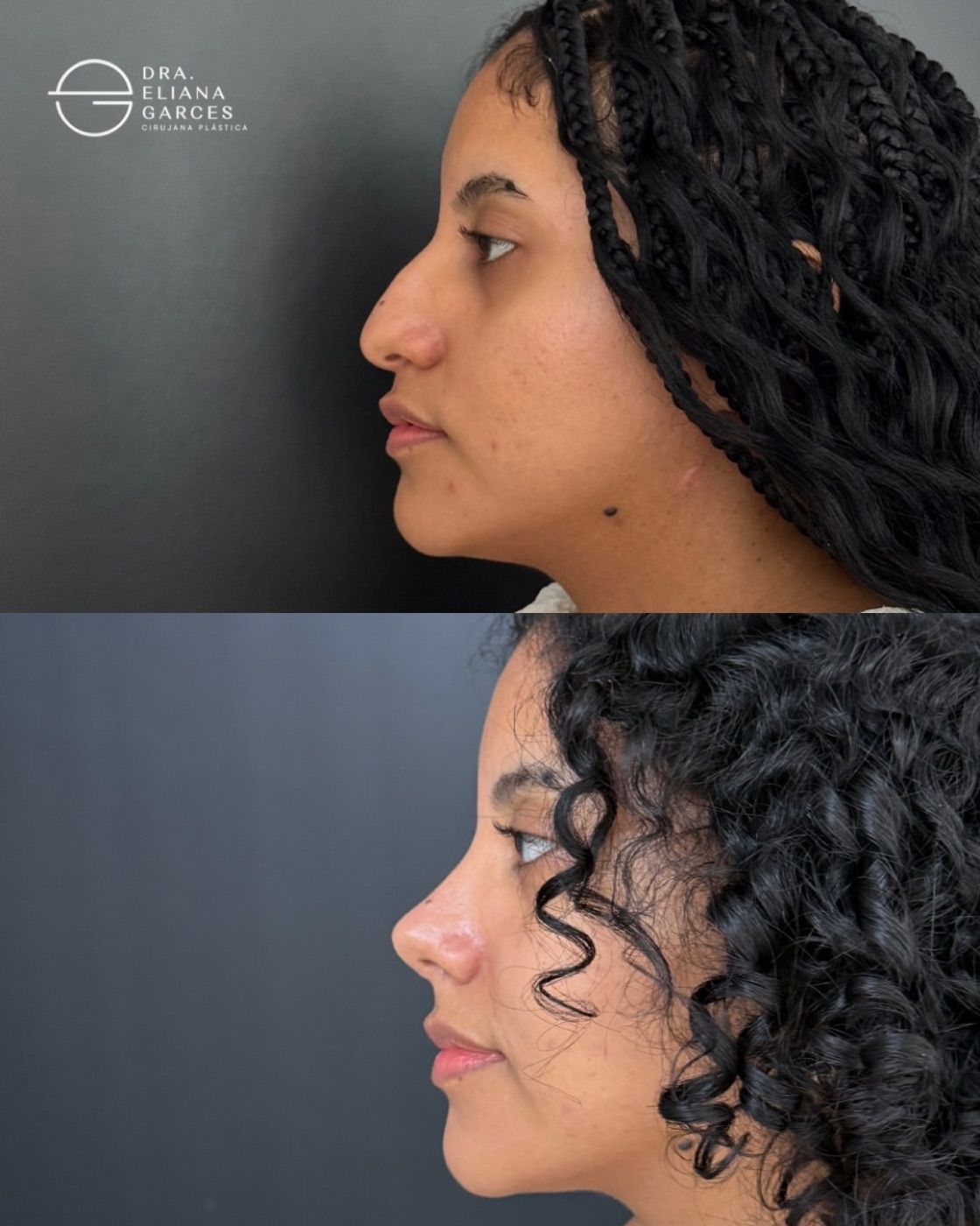 Caso real 3 de rinoplastia, perfil antes y después