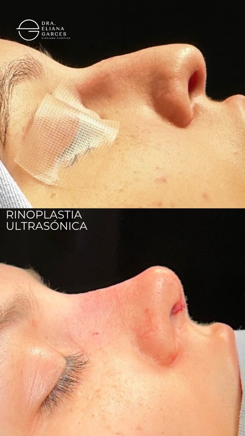 Caso real 4 de rinoplastia, perfil antes y después