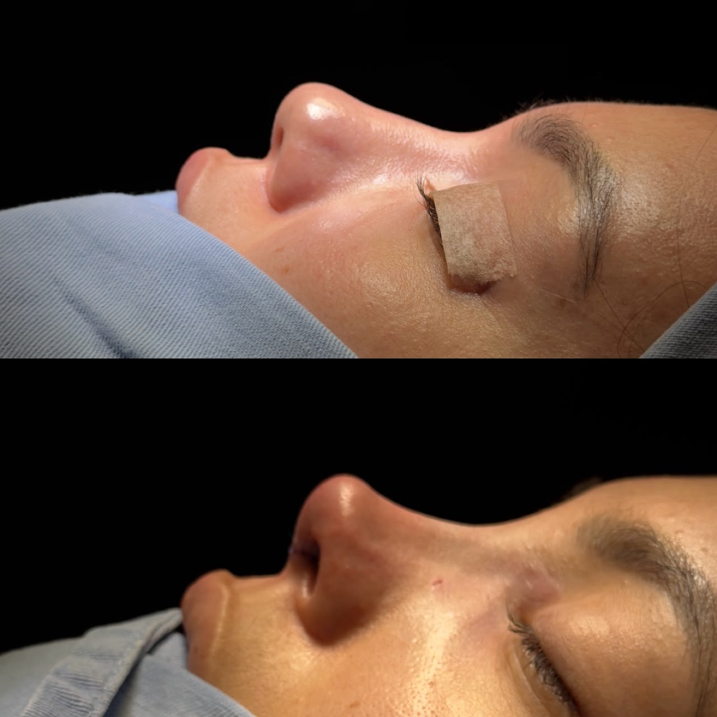 Caso real 2 de rinoplastia, perfil antes y después
