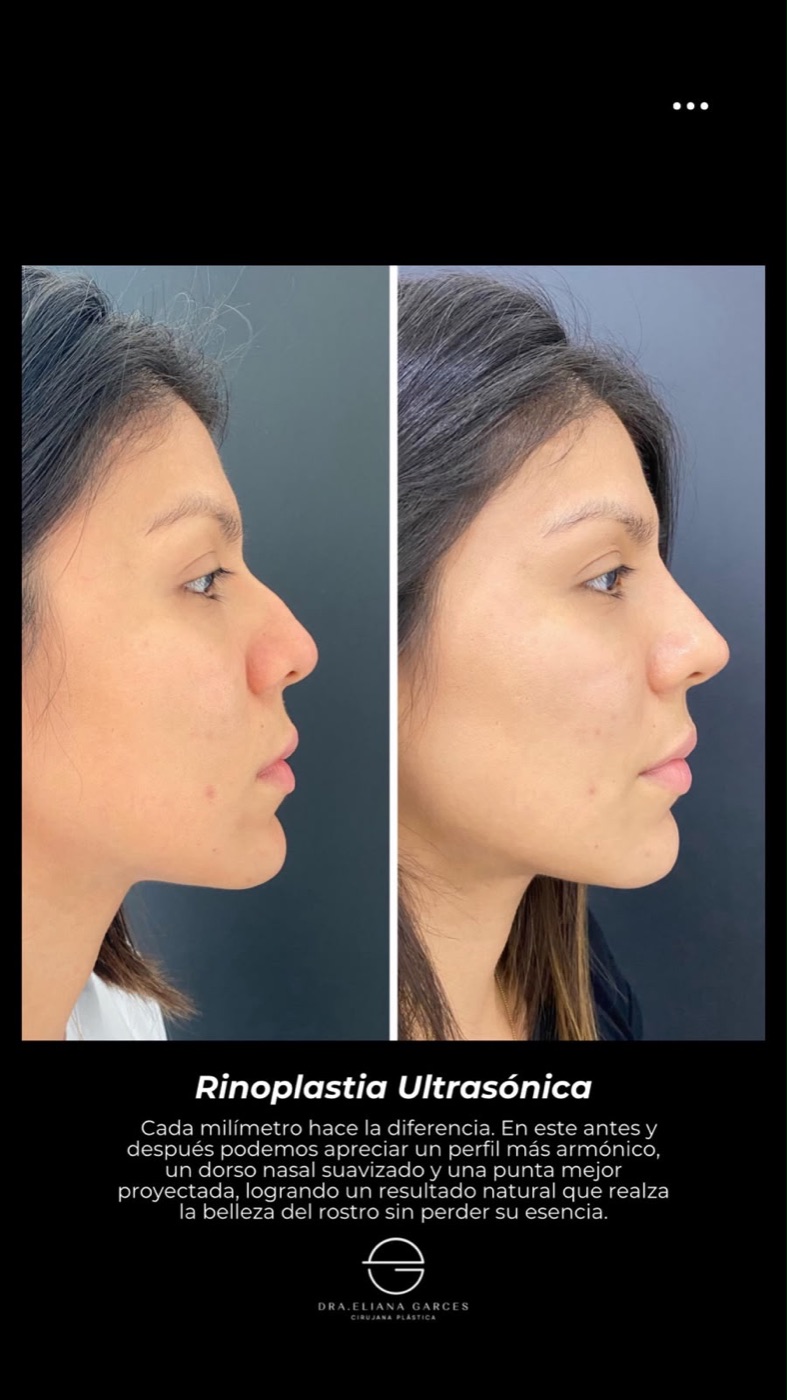 Caso real 5 de rinoplastia, perfil antes y después